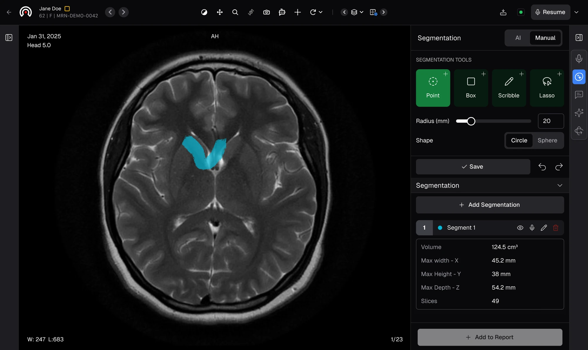 RadioView.AI segmentation panel with an AI and Manual toggle, Point, Box, Scribble, and Lasso tools, a highlighted region on a brain scan, and computed volume and dimension values ready to add to the report
