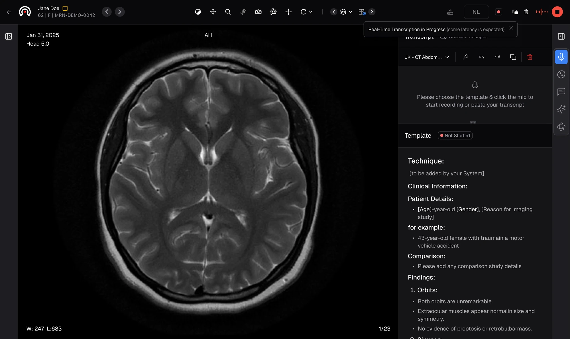 RadioView.AI DICOM viewer with a real-time voice transcription panel, a 'some latency is expected' notice, a template selector, and a structured report template filling in as the radiologist speaks
